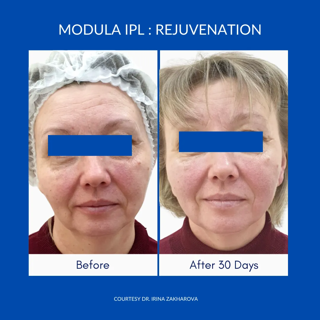 Wavemed Modula IPL