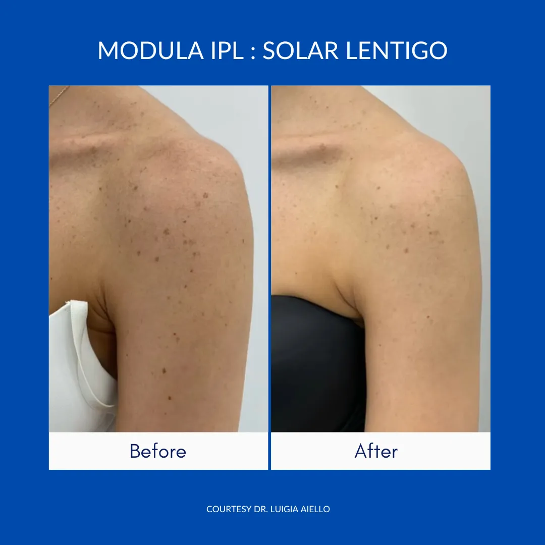 Wavemed Modula IPL