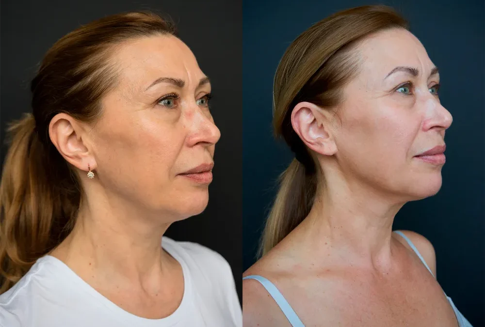 Microneedling voor en na: