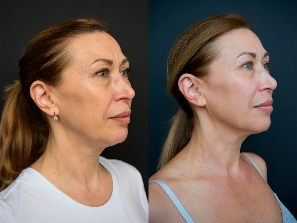 Microneedling resultaat