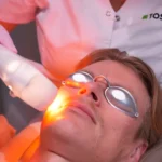 IPL gezicht behandeling