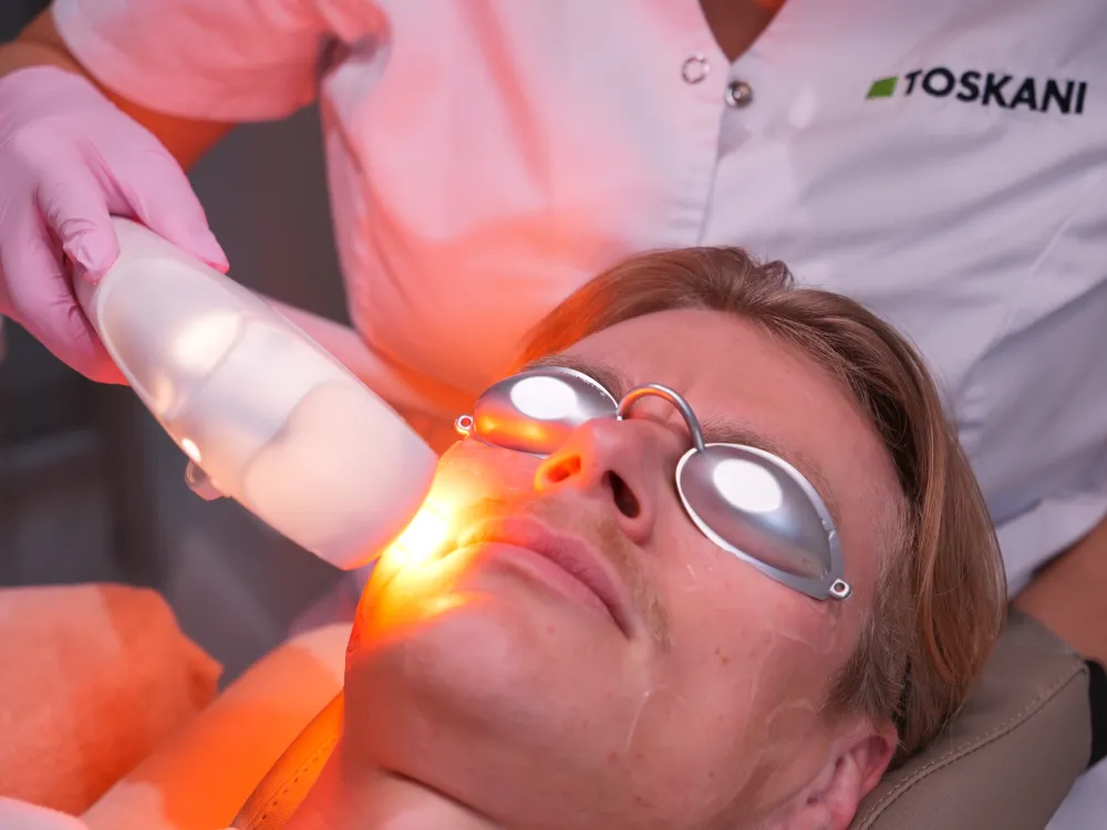 Microneedling voor en na resultaat